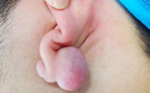 耳洞疙瘩图片,耳洞疙瘩成因及护理攻略揭秘